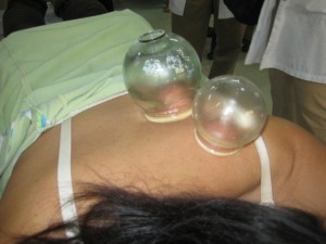 07 Cupping